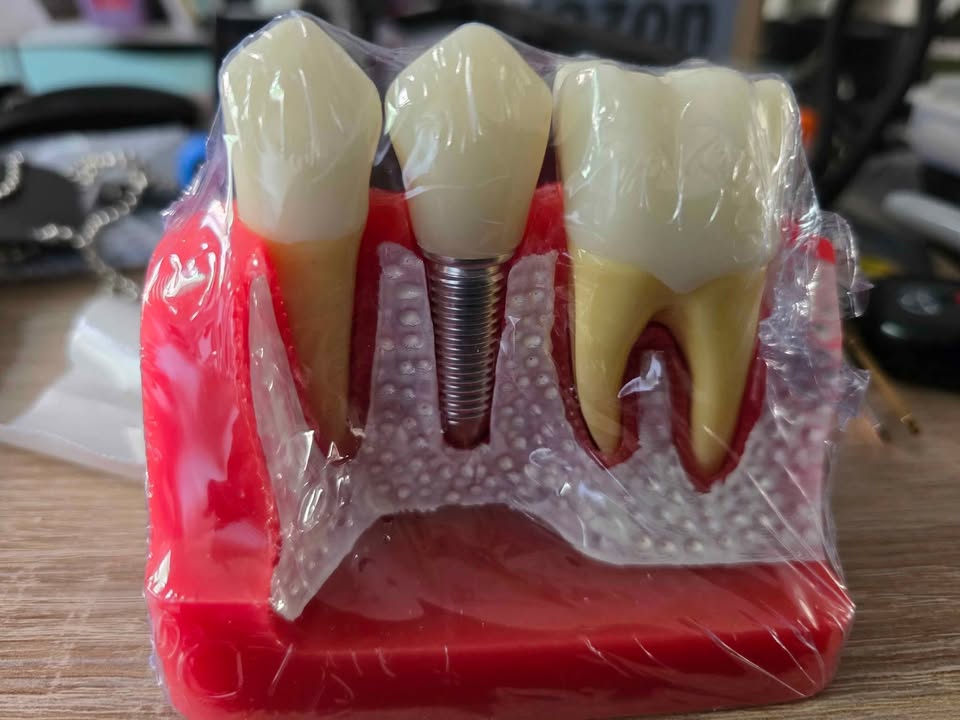 Implant Model Dental