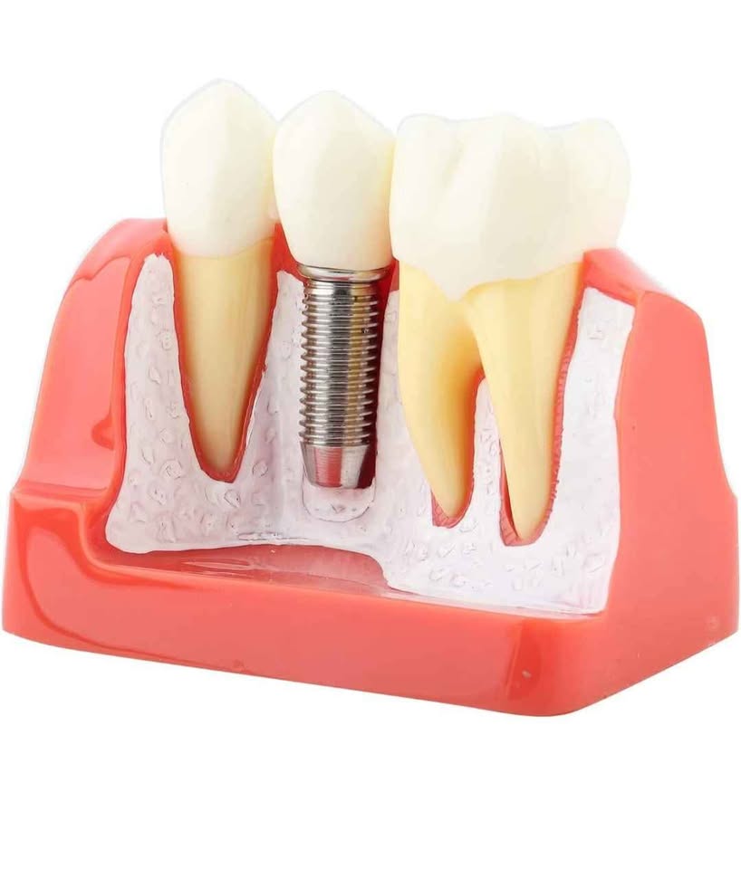 Implant Model Dental